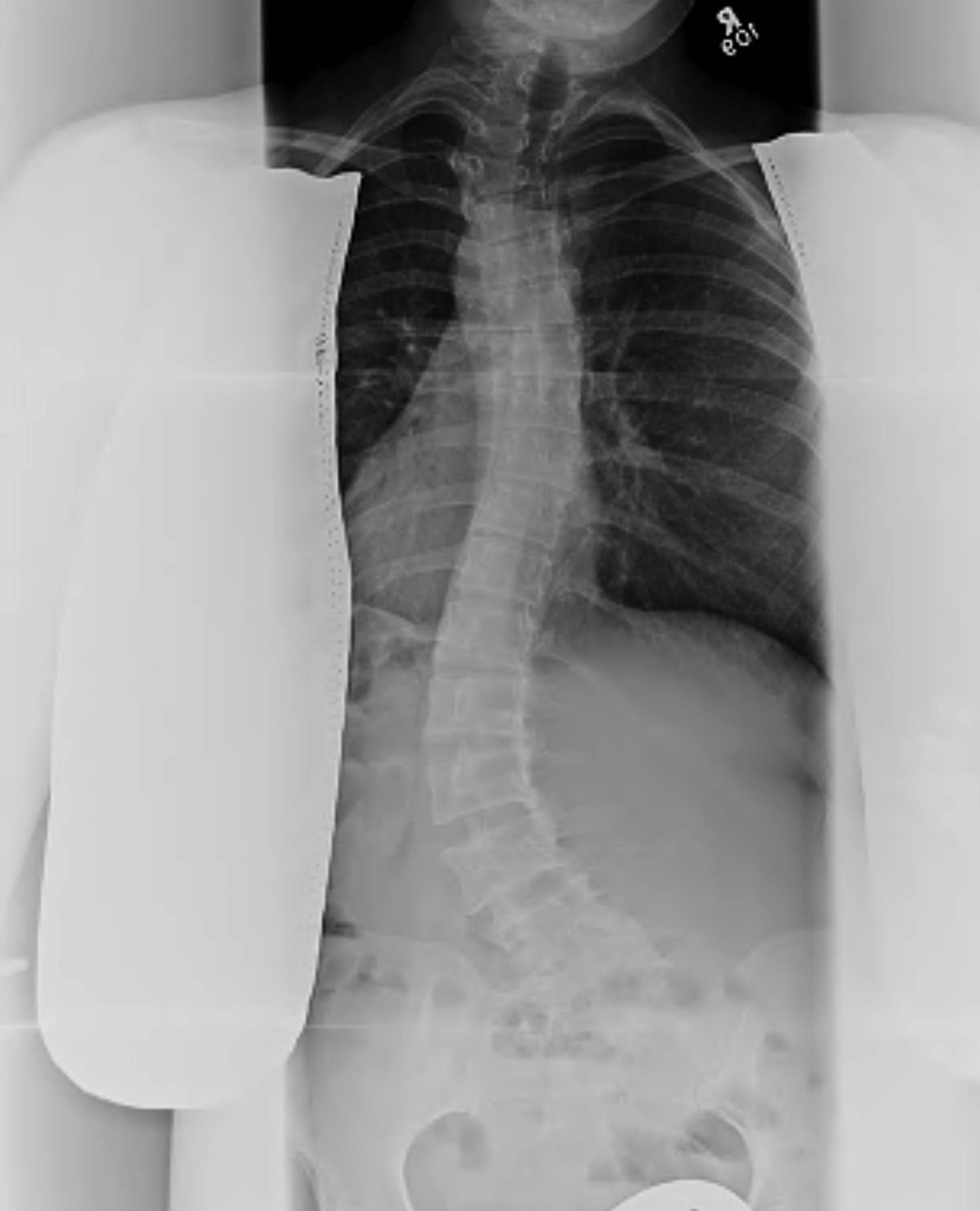 Scoliosis Left Lumbar Curve